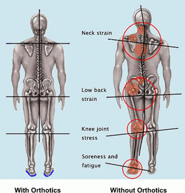 two body xrays with the left showing what your body looks like with orthotics and the right showing the effects of your body without orthotics