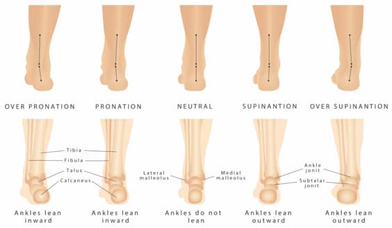 the back of 10 different heels showing the difference between different foot abnormalities